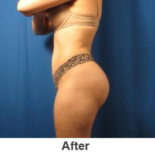 Brazilian Butt Lift - After - Patient 1a