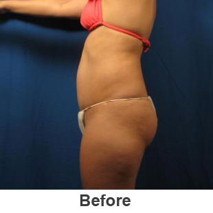 Brazilian Butt Lift - Before - Patient 1a