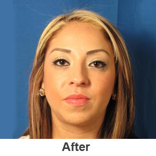 Chin Implants - After - Patient 1a