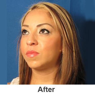 Chin Implants - After - Patient 1a