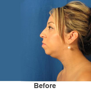 Chin Implants - Before - Patient 1a