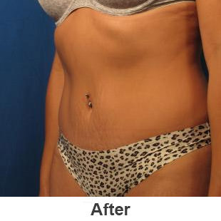 Liposuction - After - Patient 1a