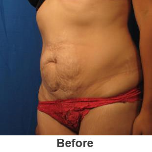 Liposuction - Before - Patient 1a