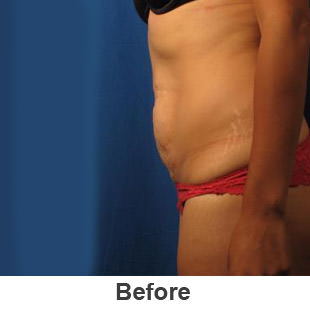 Liposuction - Before - Patient 1a