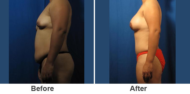 Breast Augmentation Can Restore Curves After Weight Loss - Paul C