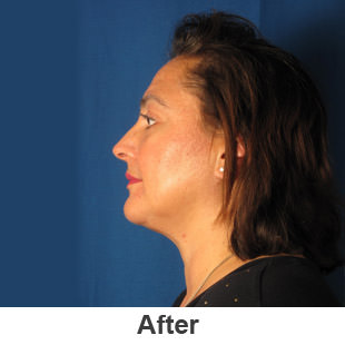 Neck Lift Rejuvenation - After - Patient 1a