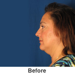 Neck Lift Rejuvenation - Before - Patient 1a