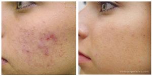 The Vivace RF Microneedling before and after