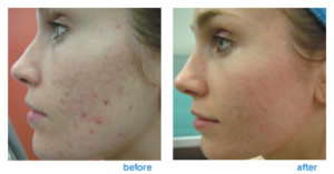 Fractional CO2 Laser Skin Resurfacing