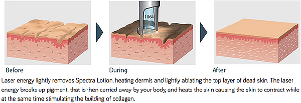 Carbon Peels process