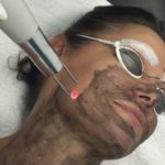 Hollywood Laser Peel