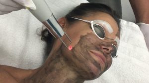 Hollywood Laser Peel