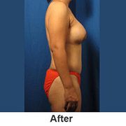 natural-breast-augmentation - After - Patient 1a