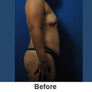 natural-breast-augmentation - Before - Patient 1a