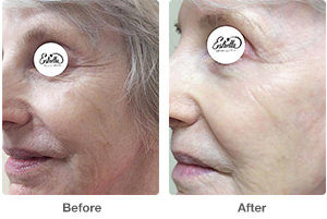 Before and After Botox Photos
