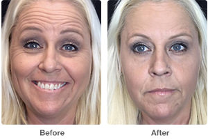 Before and After Botox Photos
