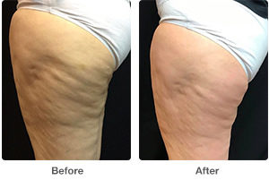 Before and After Vaser Shape Photos