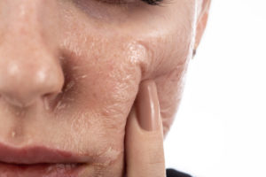 chemical peels corona ca