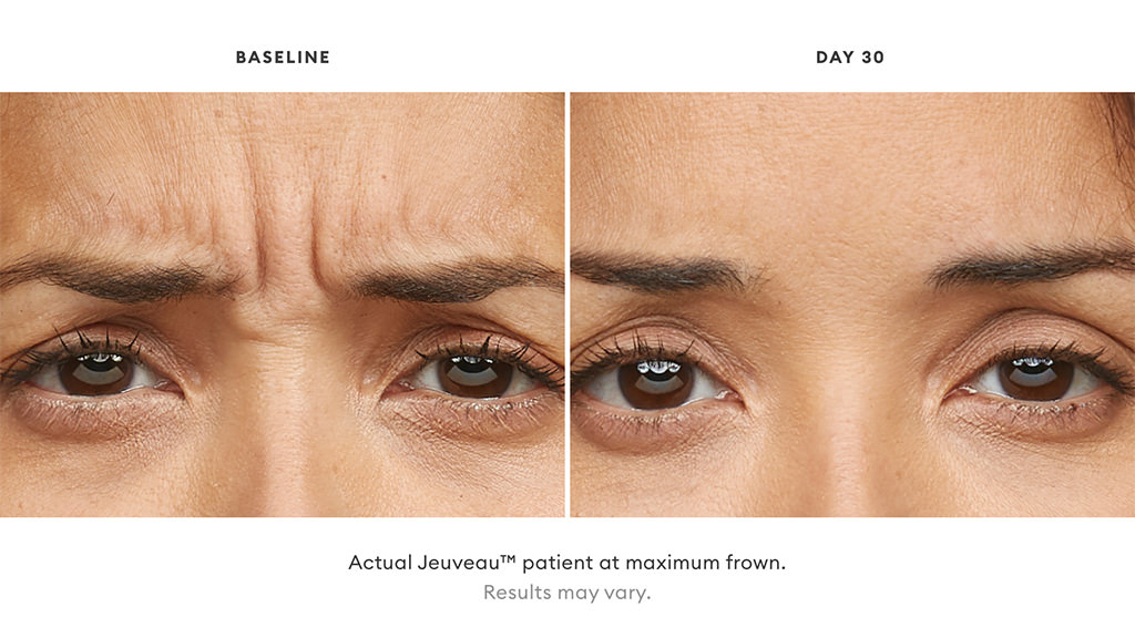 Jeuveau™ patient before and after treatment