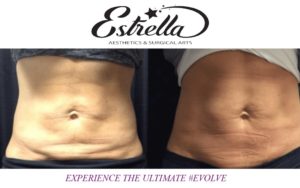 EVOLVE Body Sculpting Corona Ca.
