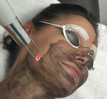 The Flawless Carbon Peel