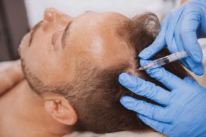 PRP injections for hair loss