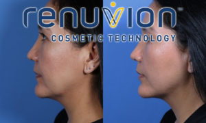 Renuvion® Skin Tightening before and after