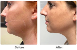 Before and After - Agnes RF