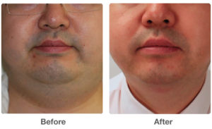 Before and After - Agnes RF
