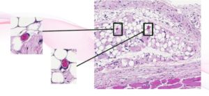 treat small volume soft tissue defects