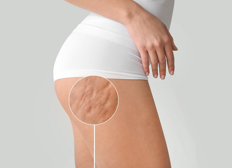 cellulite injectable treatment