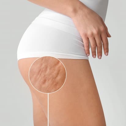 QWO Cellulite Injectable Treatment