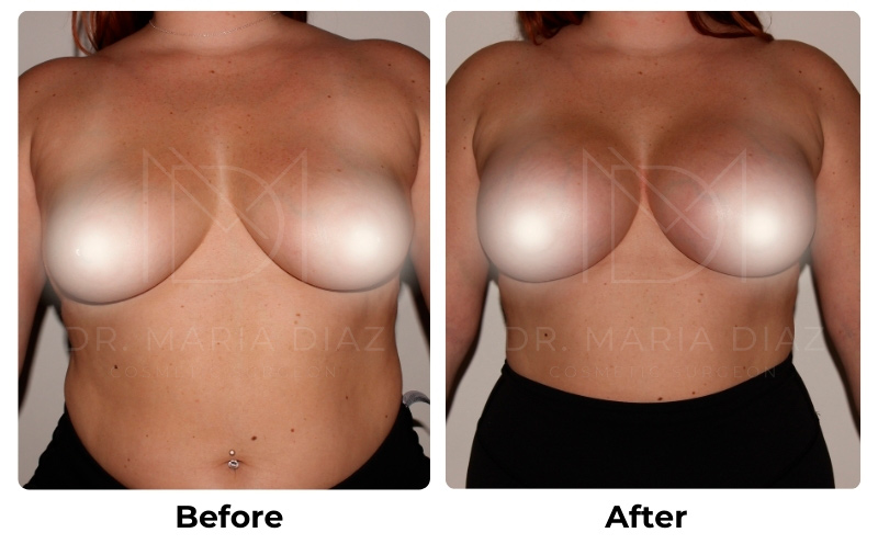 Before and After Breast Implants Photos 1