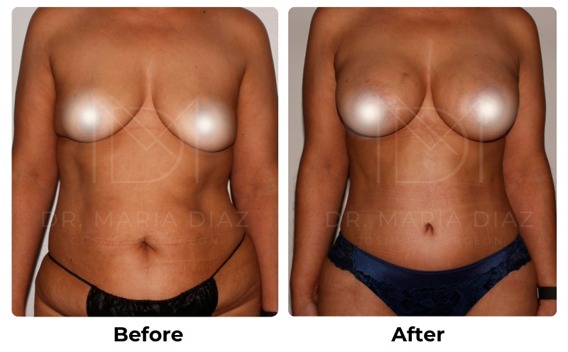 Before and After Breast Implants Photos 3