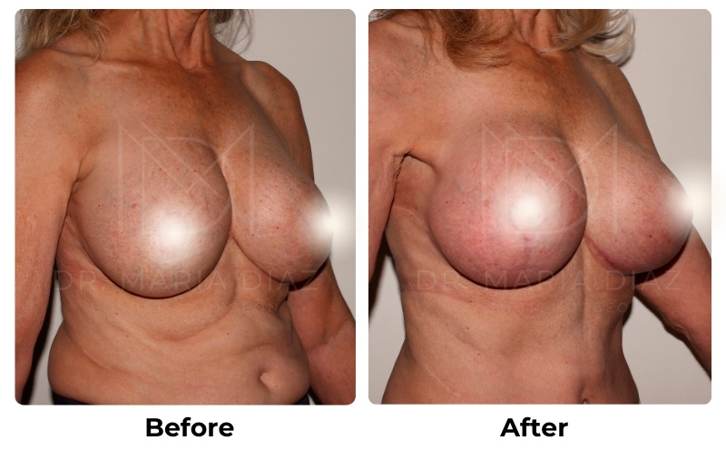 Before and After Breast Implants Photos 2