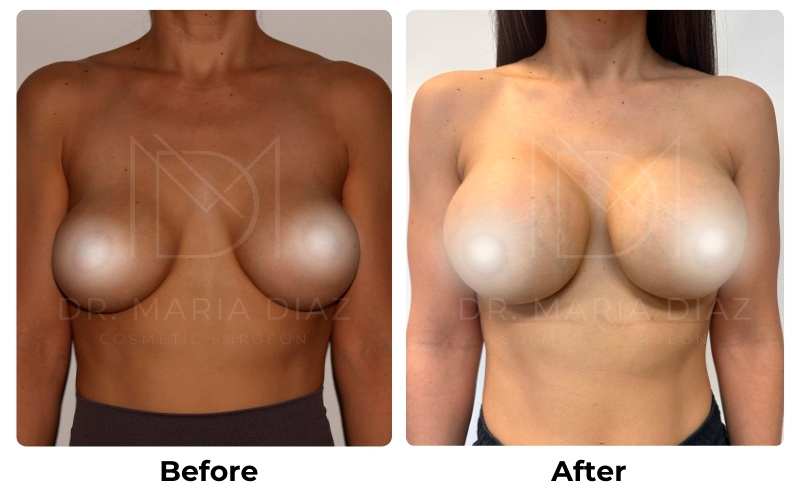 Before and After Breast Implants Photos 3