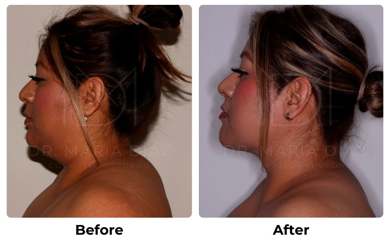 Before and After Chin Liposuction Photos 1