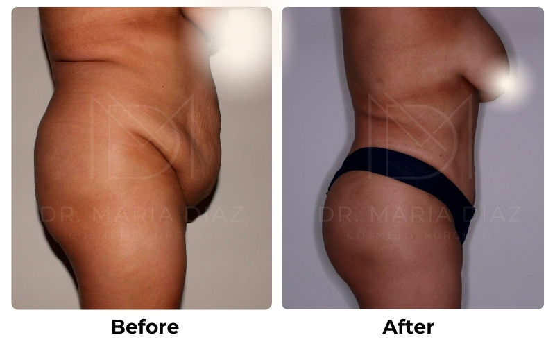 Lipo 360 + Tummy Tuck with BBL Fat Transfer Photos 1