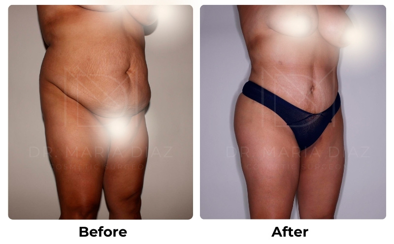 Lipo 360 + Tummy Tuck with BBL Fat Transfer Photos 2