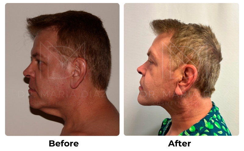 Before and After Chin Liposuction Photos 2