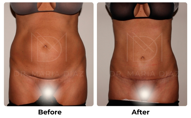 Before and After - Mini Tummy Tuck Photos 1