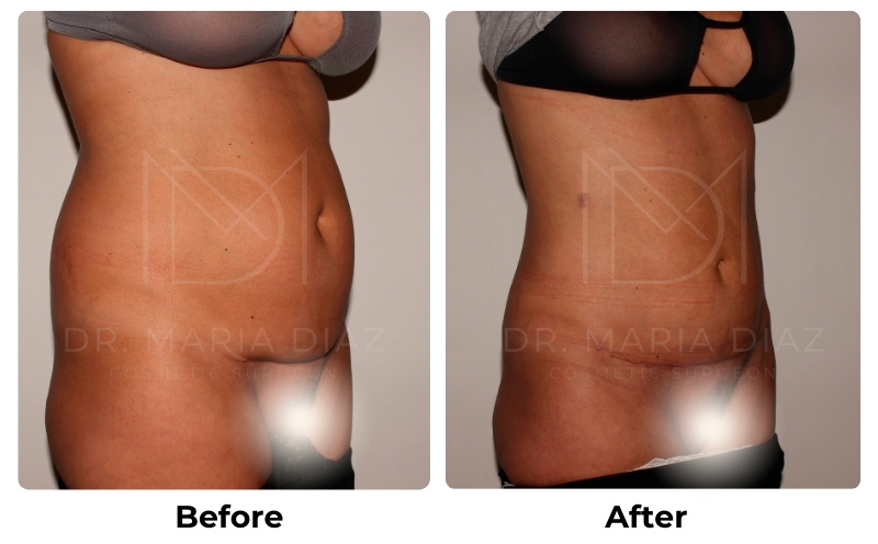 Before and After - Mini Tummy Tuck Photos 2