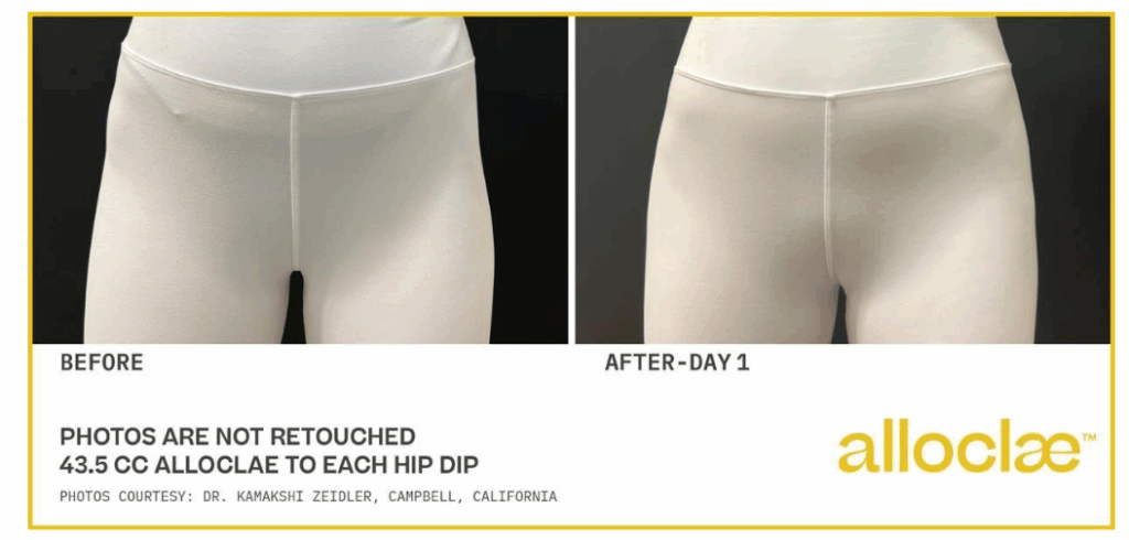 Alloclae bbl corona ca